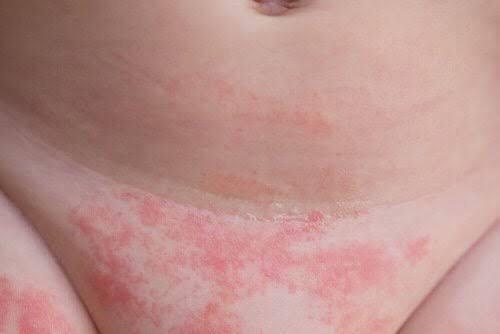 Imagem de dermatite na pele do bebê