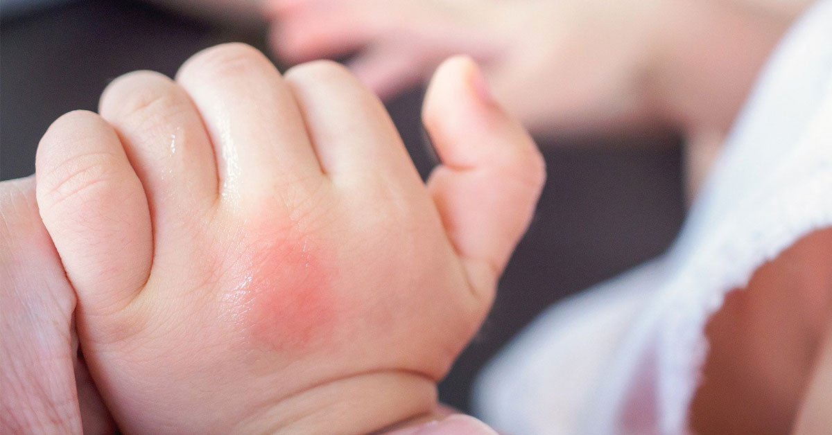 Pessoa segurando a mão de um bebê, que apresenta uma erupção cutânea vermelha visível na pele.